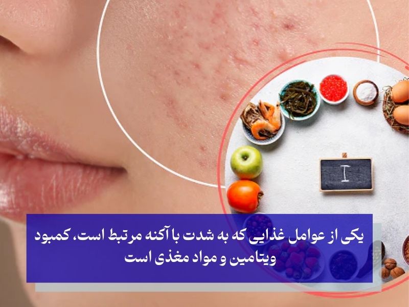 آیا کمبود مواد مغذی هم در ایجاد جوش مؤثر است