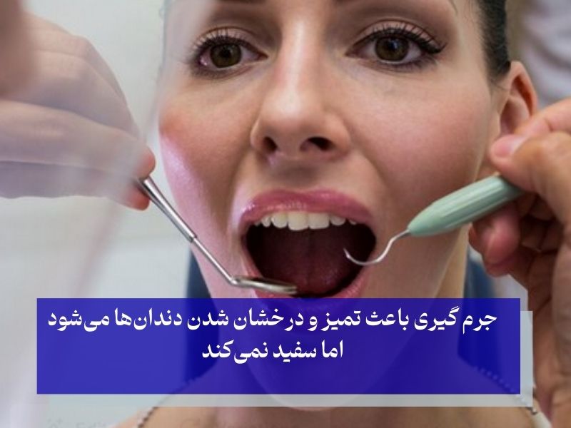 تفاوت جرم‌ گیری و سفید کردن دندان