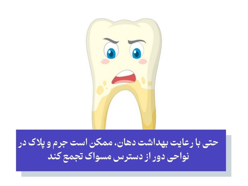 جرم‌ گیری دندان برای چه کسانی مناسب است؟