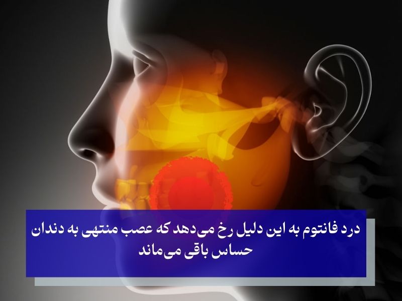 درد فانتوم بعد ار عصب کشی