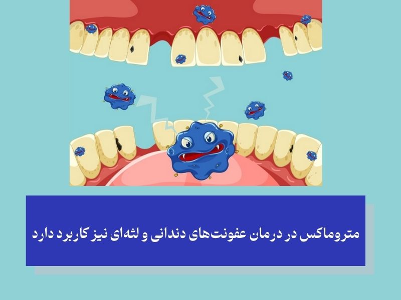 درمان عفونت‌های دندانی و لثه‌ای؛ از کاربردهای قرص متروماکس برای دندان