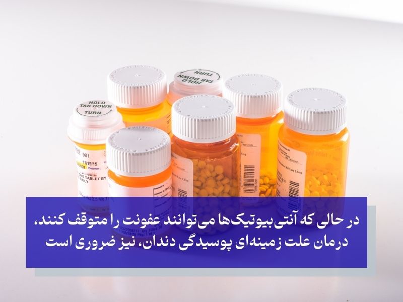 درمان عفونت‌های شدید دندان