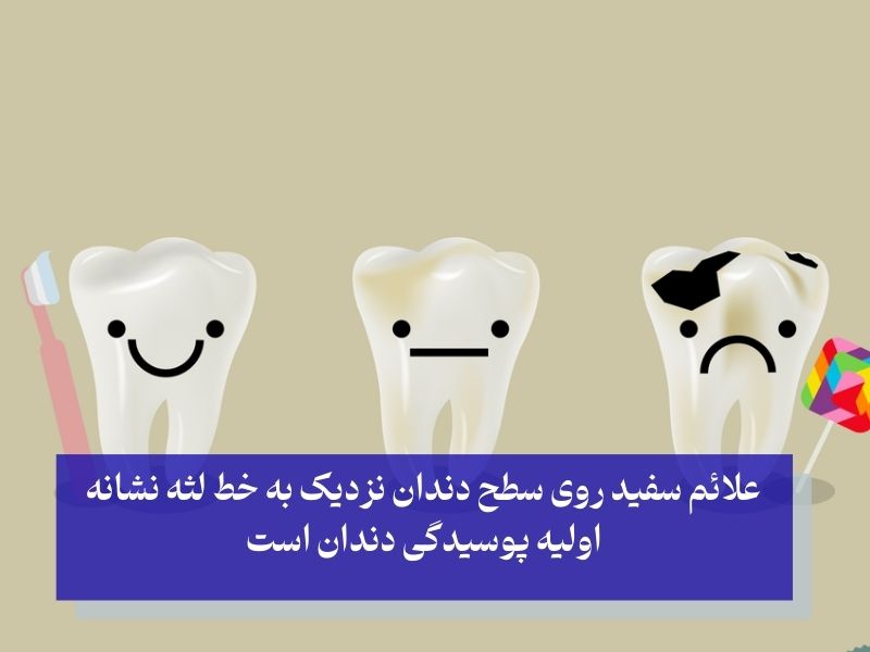 زمان شروع پوسیدگی دندان