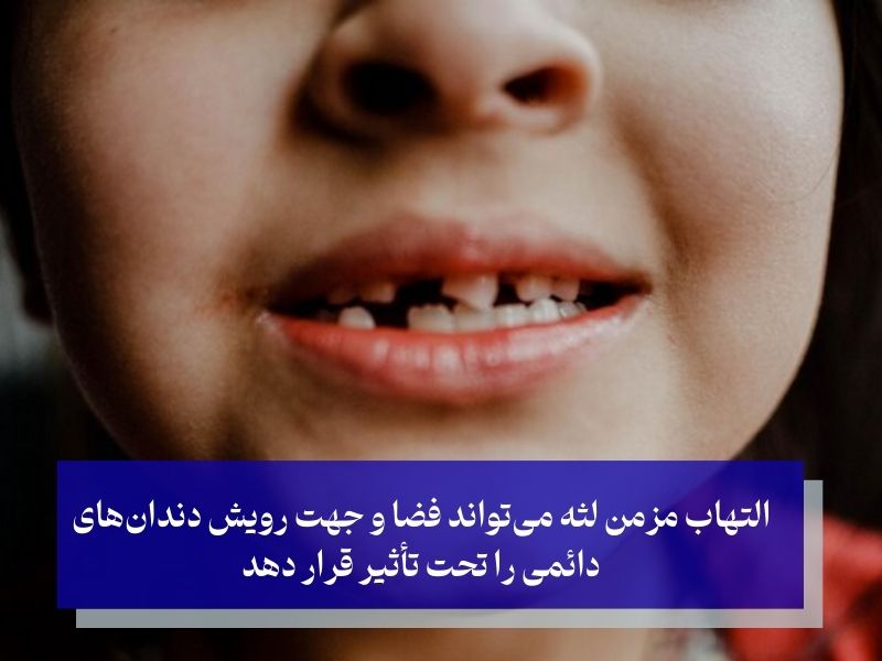 عواقب عفونت لثه در کودکان