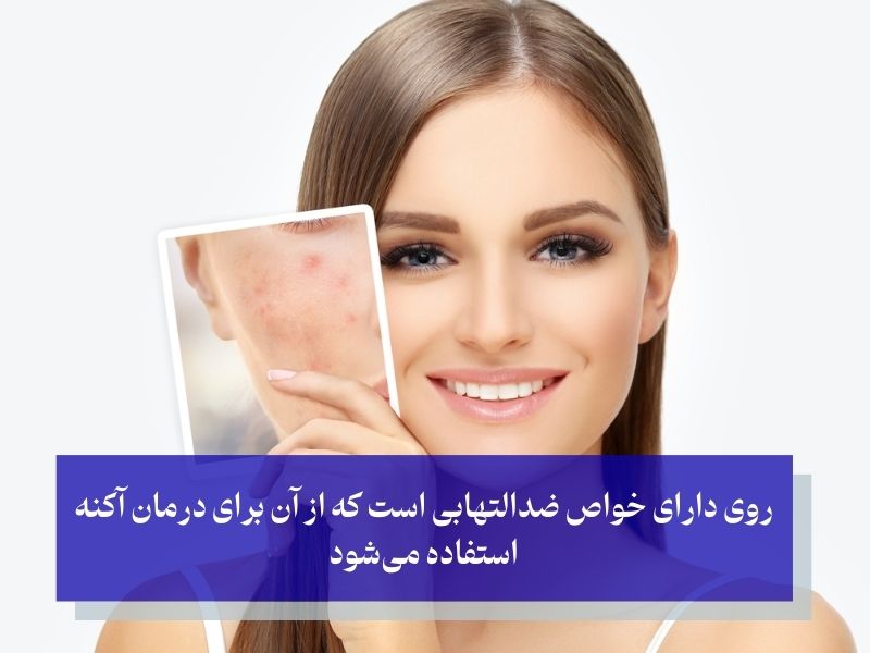 نقش روی در مدیریت آکنه