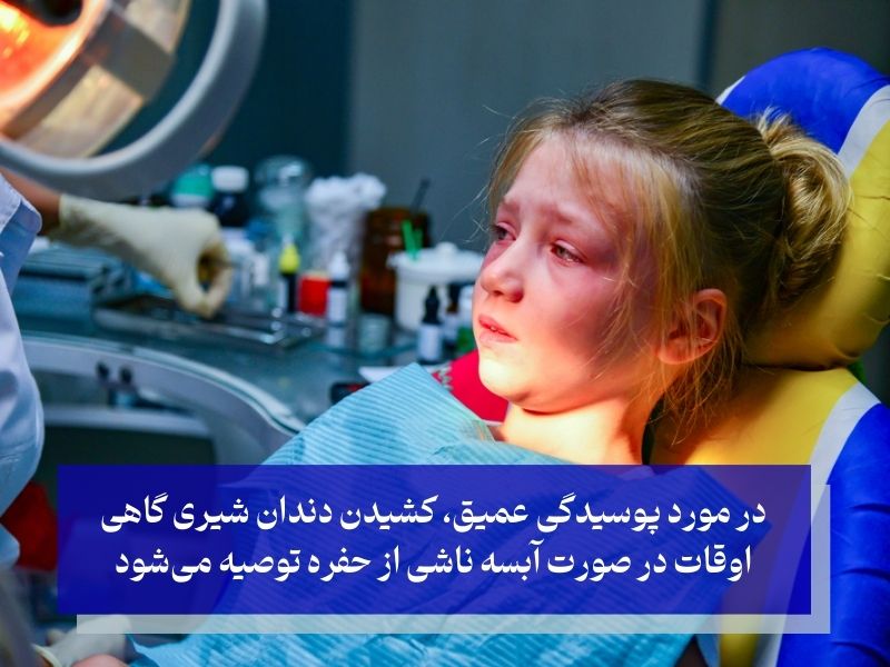 کشیدن دندان شیری