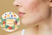 کمبود کدام ویتامین باعث جوش و آکنه می شود؟