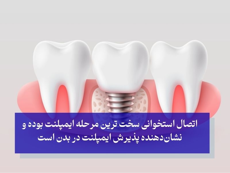 اتصال استخوانی سخت ترین مرحله ایمپلنت است