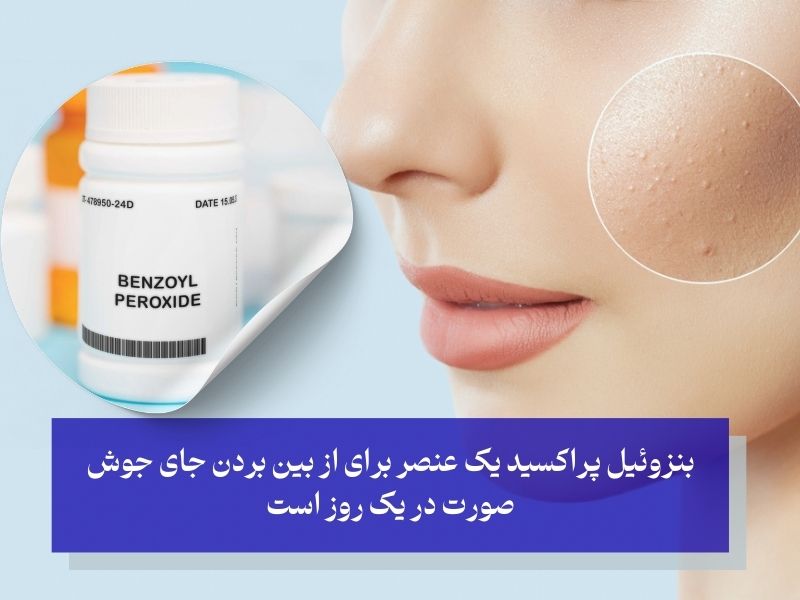 از بین بردن جای جوش در یک روز با بنزوئیل پراکسید