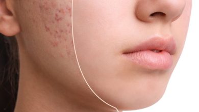 از بین بردن جوش صورت در یک روز