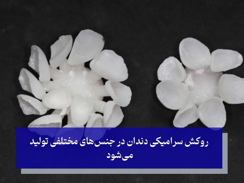 انواع روکش دندان سرامیکی