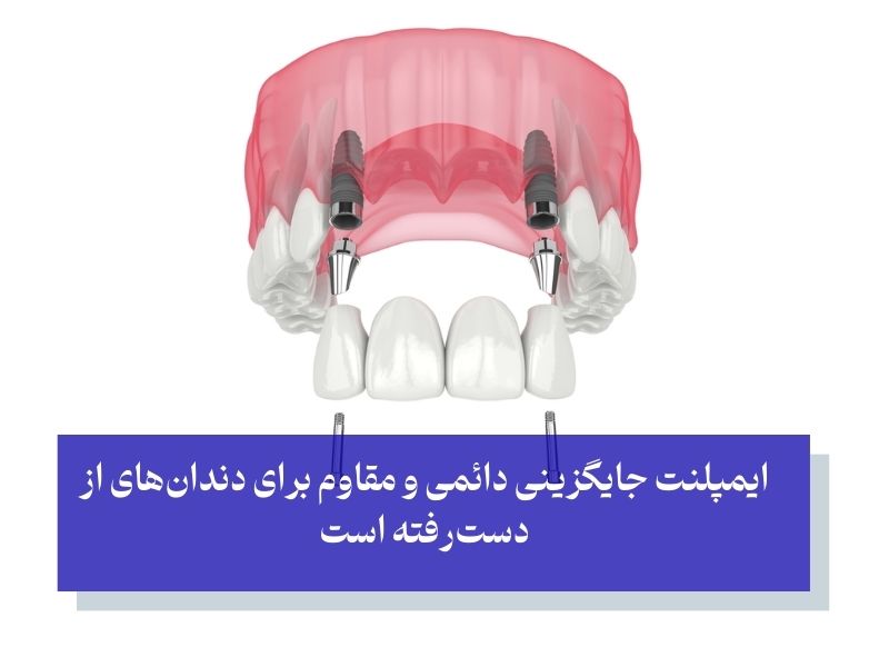 ایمپلنت دندان از انواع پروتز ثابت