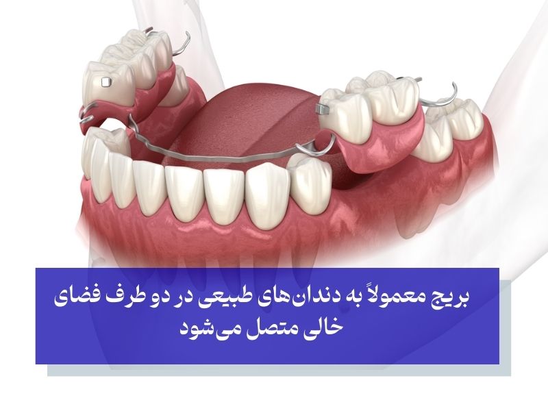 بریج از انواع پروتز دندان ثابت