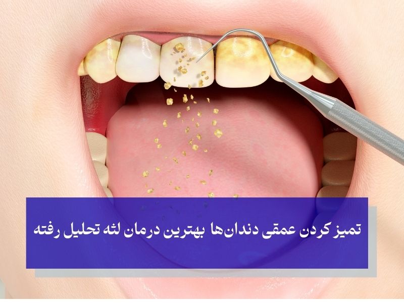 درمان لثه تحلیل رفته بدون جراحی: رویکردهای حرفه‌ای و علمی