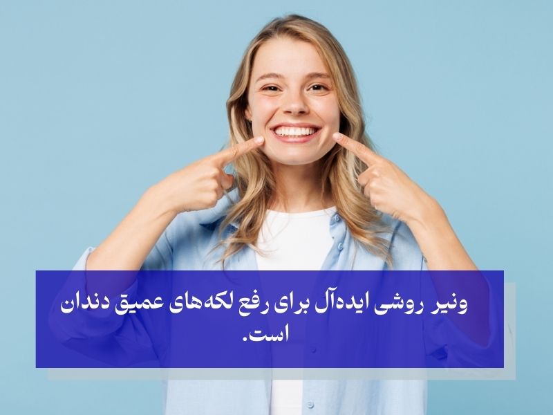 رفع زردی شدید دندان‌ با ونیر
