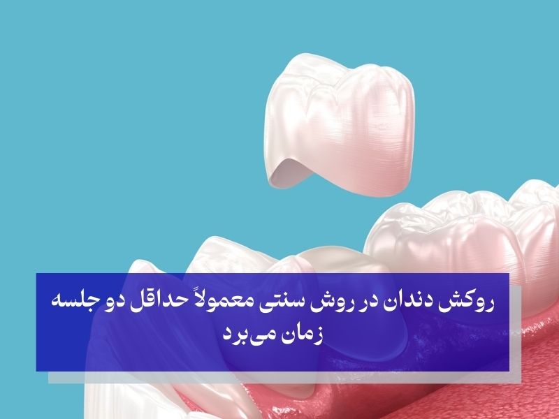 روکش دندان عصب کشی شده چقدر طول میکشد