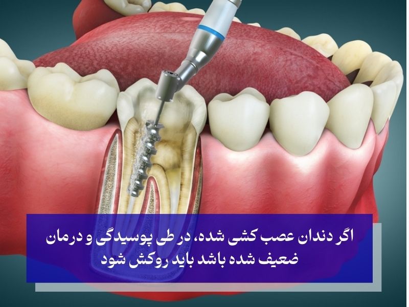 طول عمر دندان عصب کشی شده با روکش