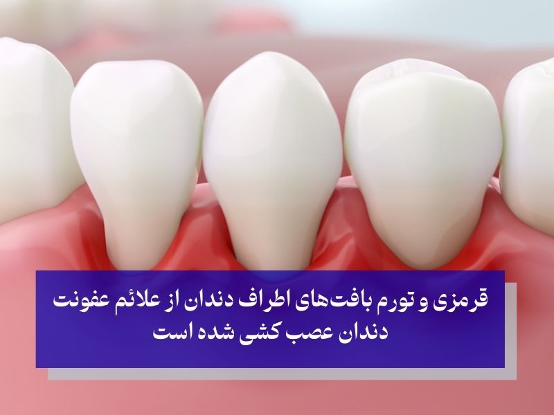 علائم عفونت دندان عصب کشی شده
