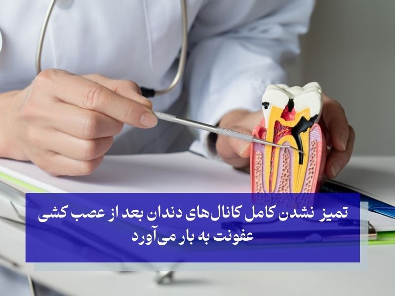 علت عفونت دندان عصب کشی شده