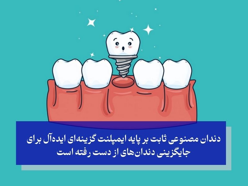 ویژگی‌ها و مزایا؛ چرا دندان مصنوعی ثابت بر پایه ایمپلنت؟