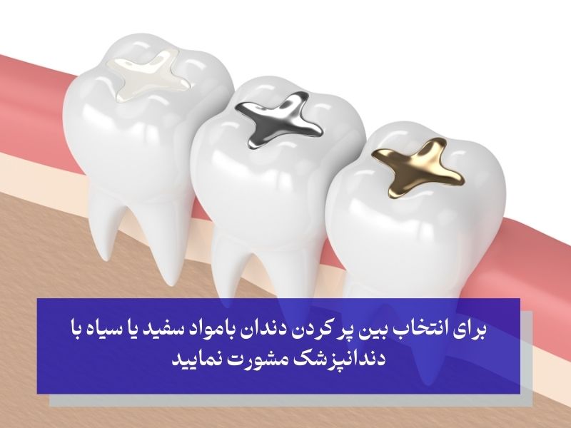 پرکردن دندان با مواد سفید خوبه یا سیاه