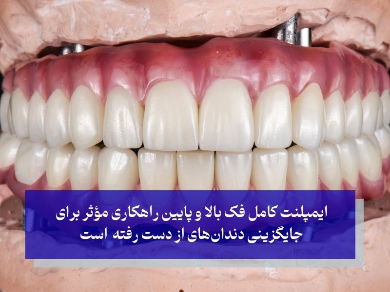 چرا ایمپلنت کامل فک بالا و پایین؟ مزایا و ضرورت‌ها