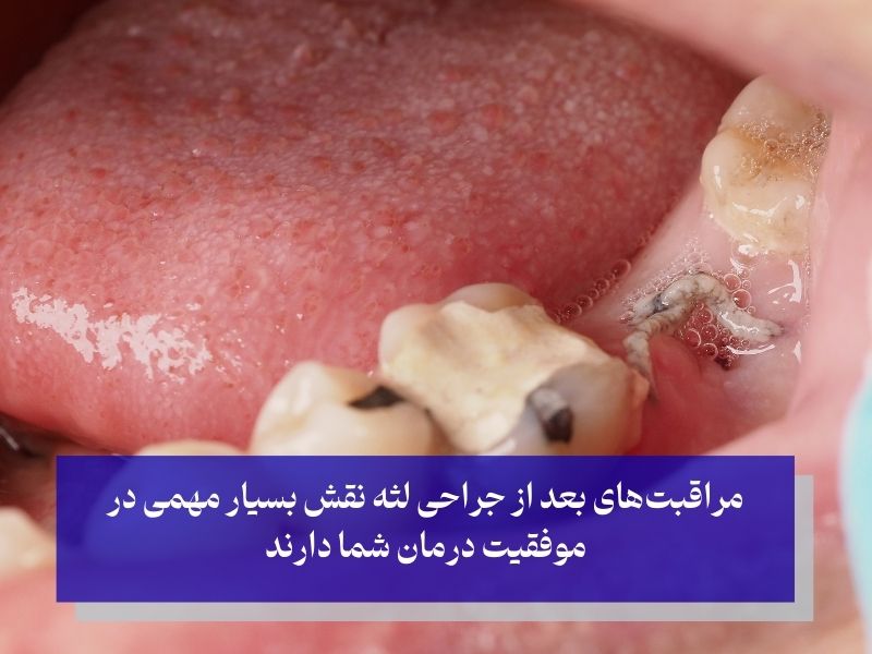 چرا مراقبت های بعد از جراحی لثه بسیار حیاتی است