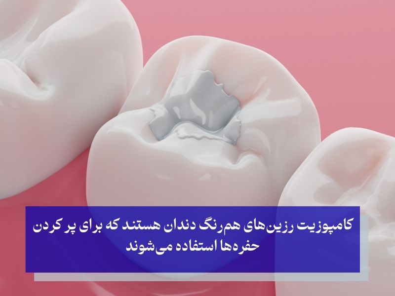 کامپوزیت برای پر کردن دندان