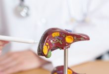 درمان کبد چرب گرید 2