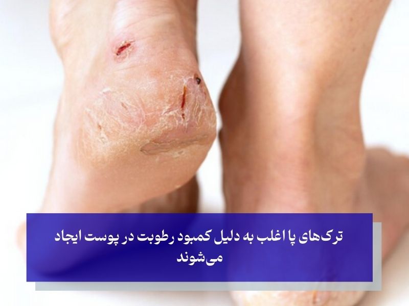 شناخت دلایل خشکی و ترک پا؛ چرا پاها ترک می‌خورند؟