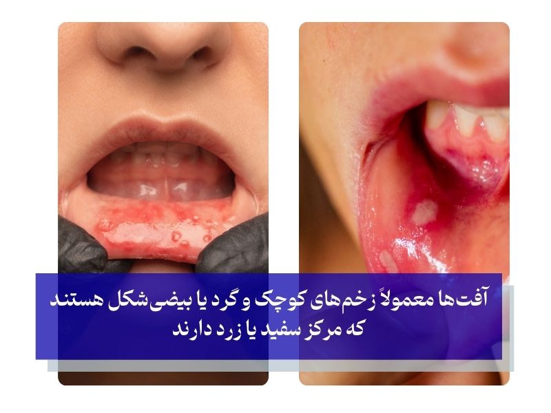 علائم آفت دهانی