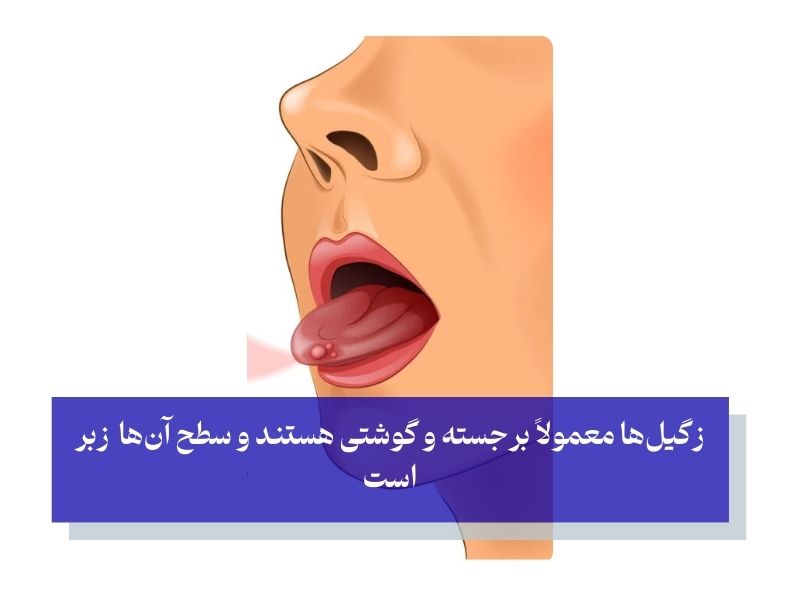 علائم زگیل دهانی