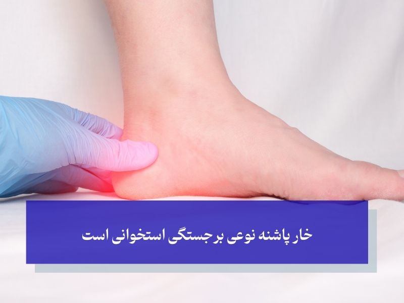 خار پاشنه نوعی برجستگی استخوانی است