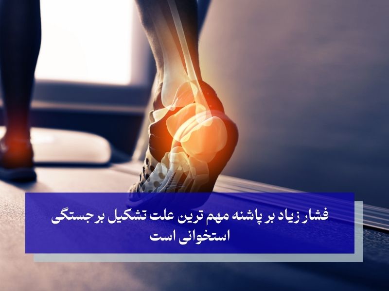 فشار زیاد بر پاشنه مهم ترین علت تشکیل برجستگی استخوانی است