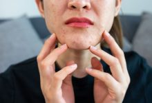 لکه های قرمز روی پوست