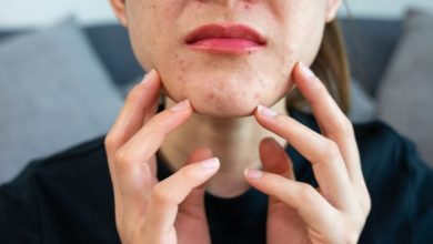 لکه‌ های قرمز روی پوست