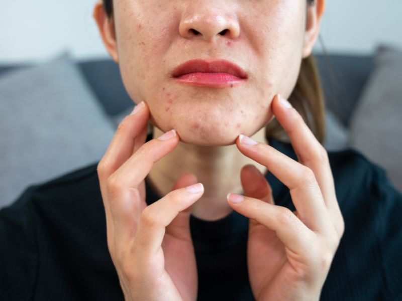 لکه‌ های قرمز روی پوست