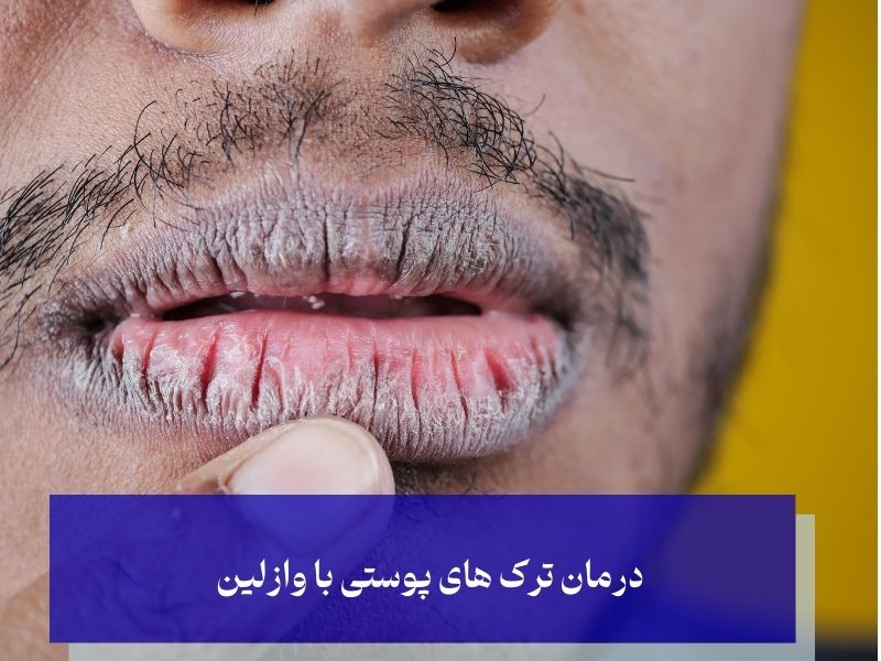 درمان ترک های پوستی با وازلین