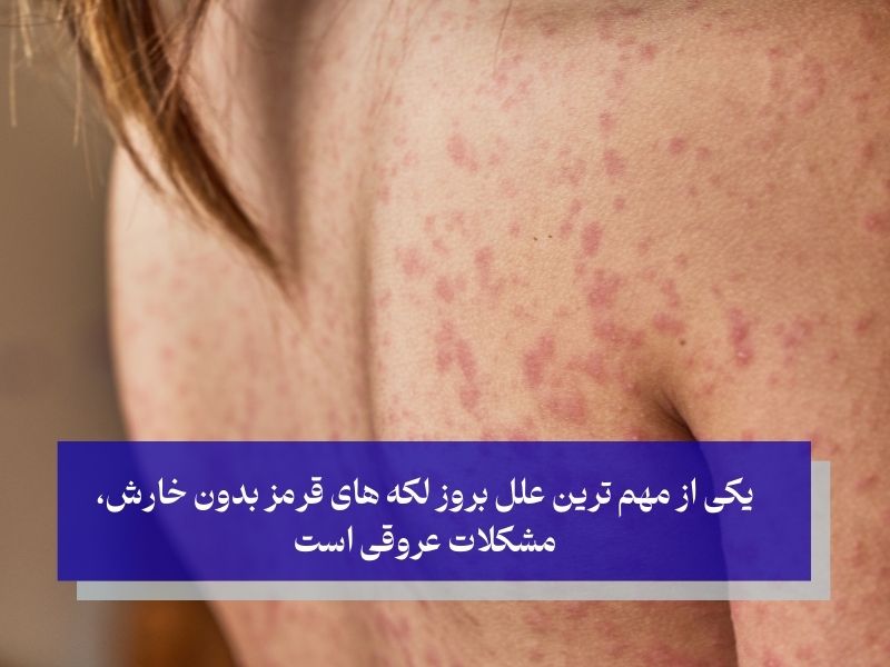 یکی از مهمترین علل لکه های قرمز بدون خارش، مشکلات عروقی است