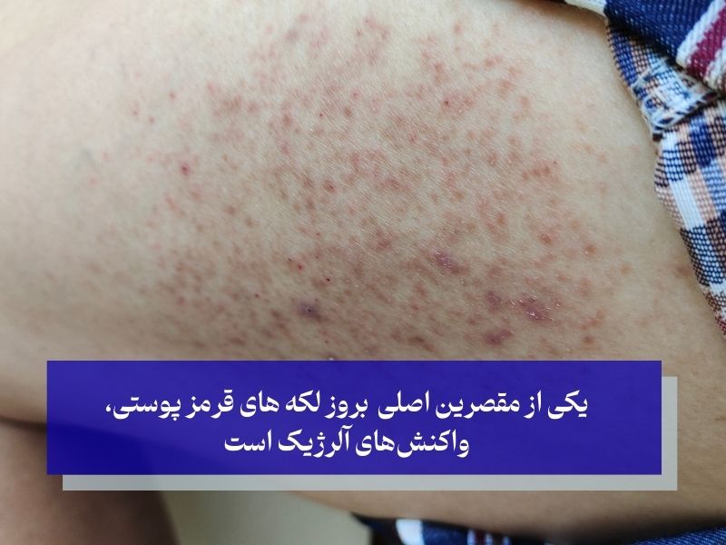 یکی از مقصرین اصلی بروز لکه های قرمز پوستی، واکنش‌های آلرژیک است