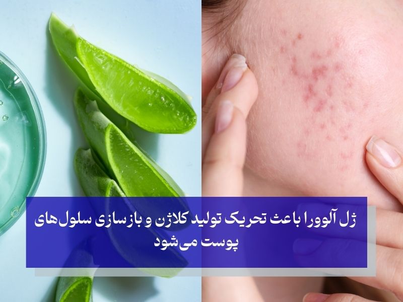 ژل آلوورا برای بهبودی زخم