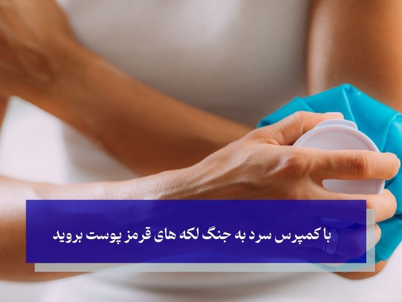 با کمپرس سرد به جنگ لکه های قرمز پوست بروید