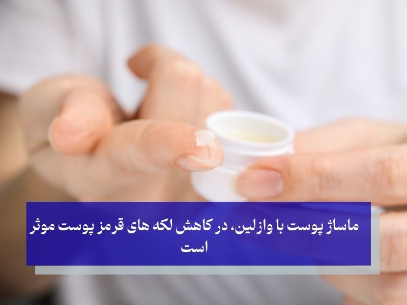 ماساژ پوست با وازلین، در کاهش لکه های قرمز پوست موثر است