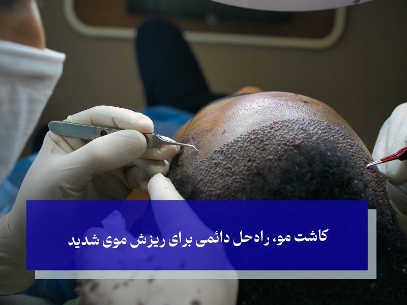 کاشت مو راه حل نهایی