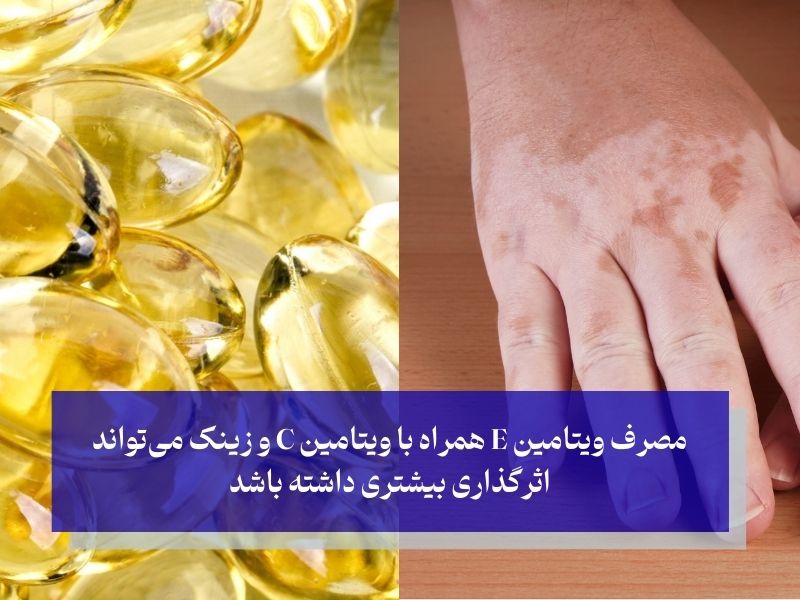 مصرف ویتامین E برای لکههای سفید روی پوست