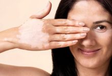 کمبود چه ویتامینی باعث پیسی میشود