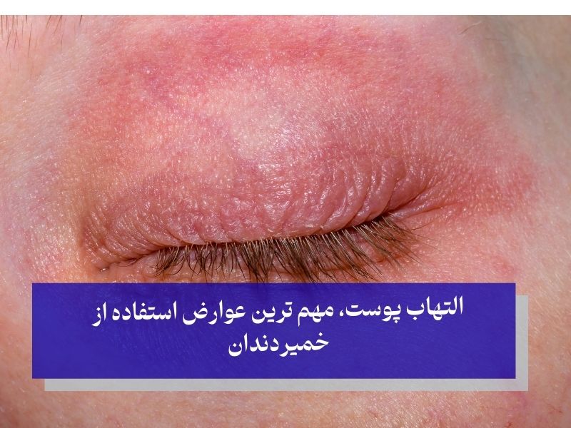 التهاب پوست مهم ترین عوارض خمیر دندان