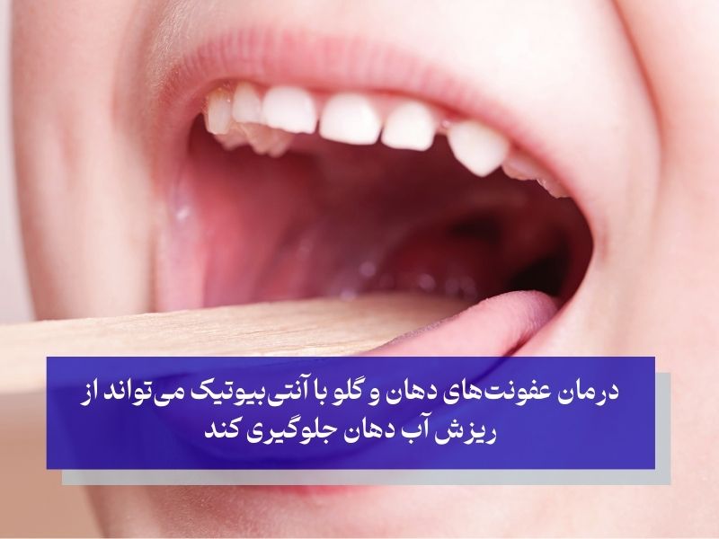 عفونت‌ها و التهابات دهان و گلو