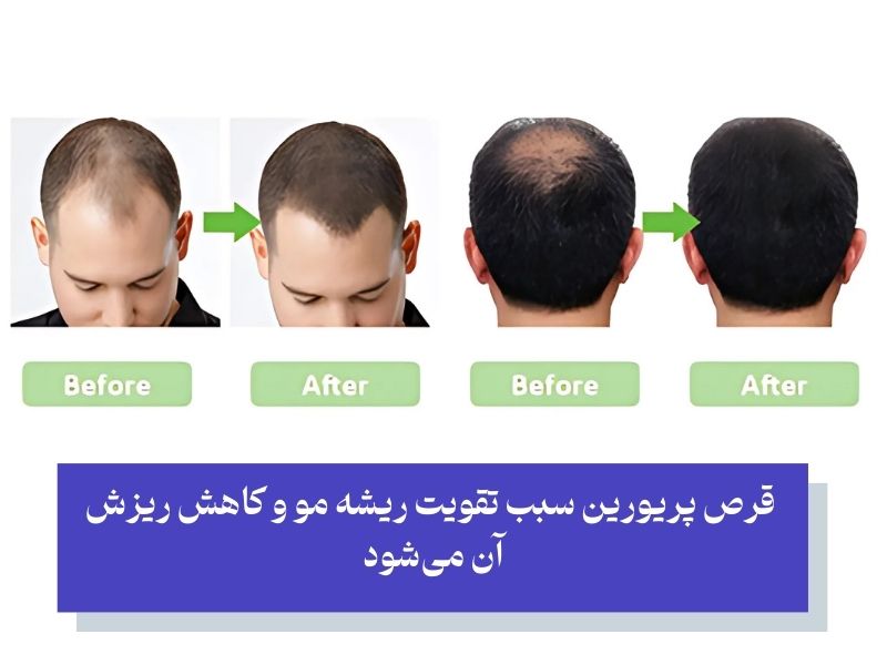 اثرات قرص پریورین در تقویت و پرپشت شدن مو