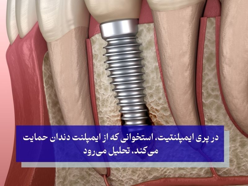 بیماری پری ایمپلنت چیست؟